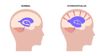 Normal Pressure Hydrocephalus