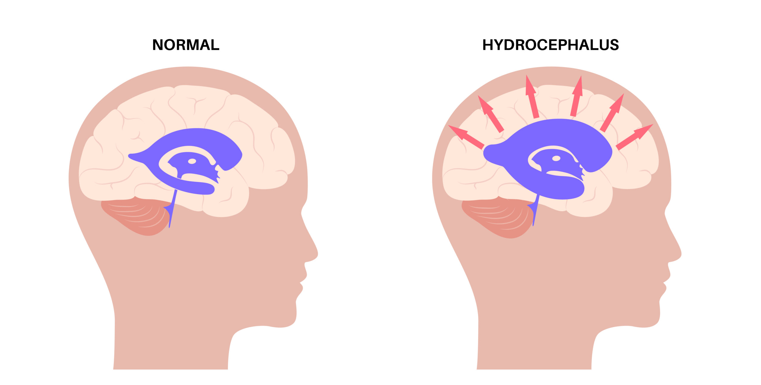 Normal Pressure Hydrocephalus